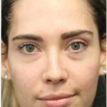 Aesthetic Facial Balancing Before & After Patient #1145