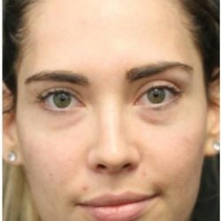 Aesthetic Facial Balancing Before & After Patient #1145