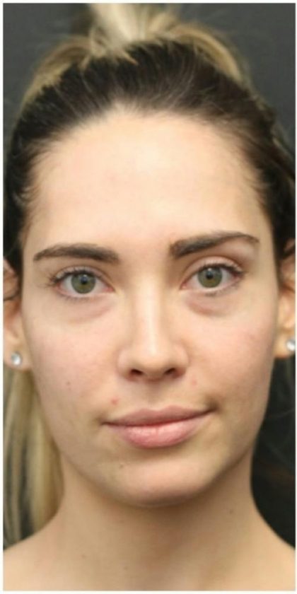 Aesthetic Facial Balancing Before & After Patient #1145
