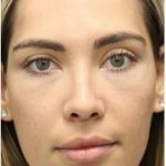 Aesthetic Facial Balancing Before & After Patient #1145