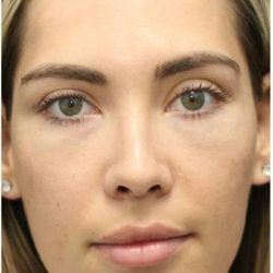 Aesthetic Facial Balancing Before & After Patient #1145