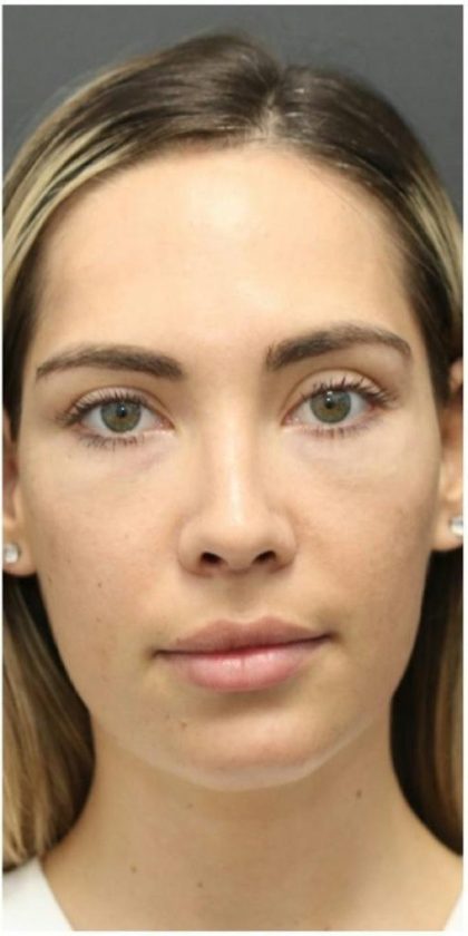 Aesthetic Facial Balancing Before & After Patient #1145