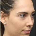 Aesthetic Facial Balancing Before & After Patient #1145
