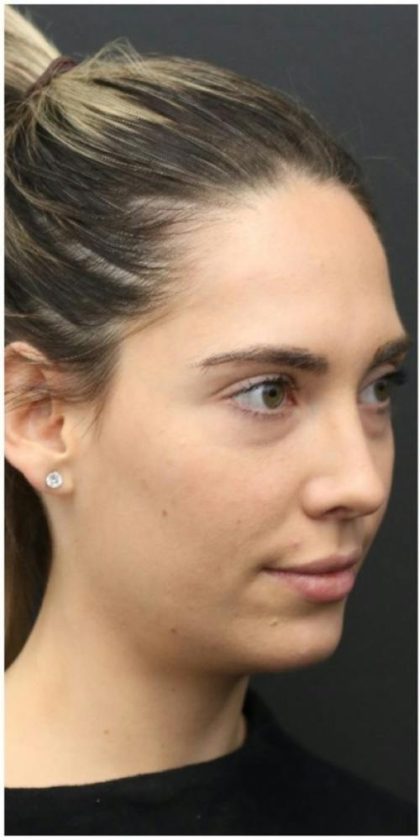 Aesthetic Facial Balancing Before & After Patient #1145