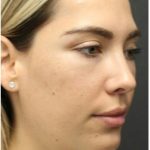 Aesthetic Facial Balancing Before & After Patient #1145