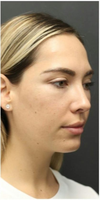 Aesthetic Facial Balancing Before & After Patient #1145