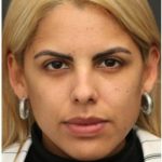 Aesthetic Facial Balancing Before & After Patient #1138