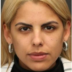 Aesthetic Facial Balancing Before & After Patient #1138