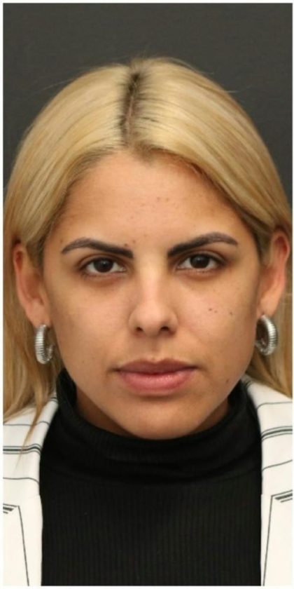 Aesthetic Facial Balancing Before & After Patient #1138