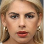Aesthetic Facial Balancing Before & After Patient #1138