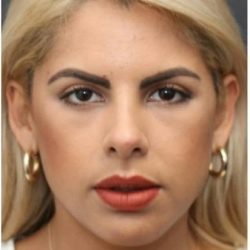 Aesthetic Facial Balancing Before & After Patient #1138