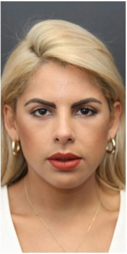Aesthetic Facial Balancing Before & After Patient #1138