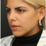 Aesthetic Facial Balancing Before & After Patient #1138