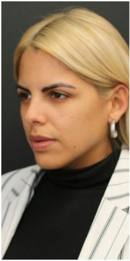 Aesthetic Facial Balancing Before & After Patient #1138