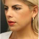 Aesthetic Facial Balancing Before & After Patient #1138