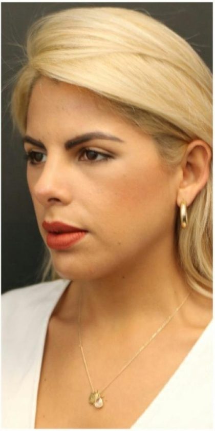 Aesthetic Facial Balancing Before & After Patient #1138