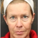 Aesthetic Facial Balancing Before & After Patient #1137