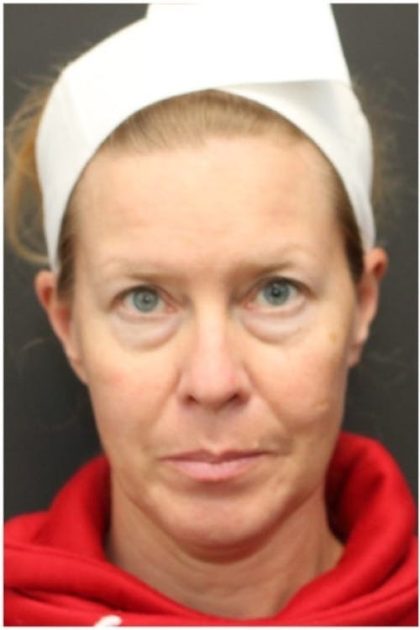 Aesthetic Facial Balancing Before & After Patient #1137