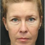 Aesthetic Facial Balancing Before & After Patient #1137
