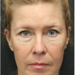 Aesthetic Facial Balancing Before & After Patient #1137