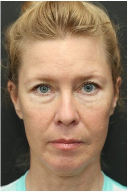 Aesthetic Facial Balancing Before & After Patient #1137