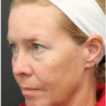 Aesthetic Facial Balancing Before & After Patient #1137