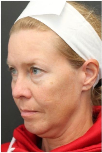 Aesthetic Facial Balancing Before & After Patient #1137