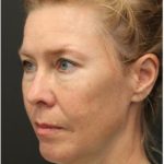 Aesthetic Facial Balancing Before & After Patient #1137