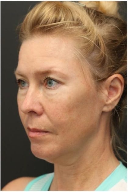 Aesthetic Facial Balancing Before & After Patient #1137
