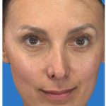 Aesthetic Facial Balancing Before & After Patient #1136