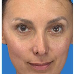 Aesthetic Facial Balancing Before & After Patient #1136