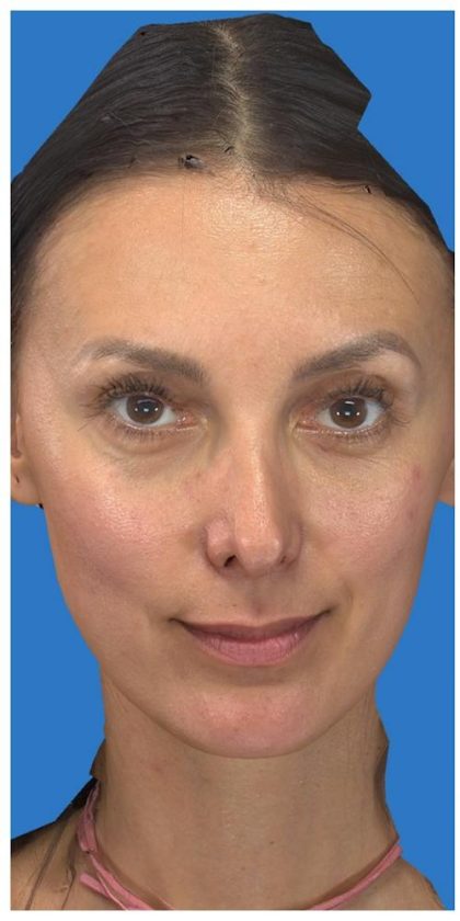 Aesthetic Facial Balancing Before & After Patient #1136