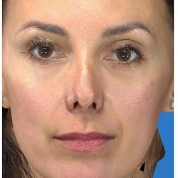 Aesthetic Facial Balancing Before & After Patient #1136