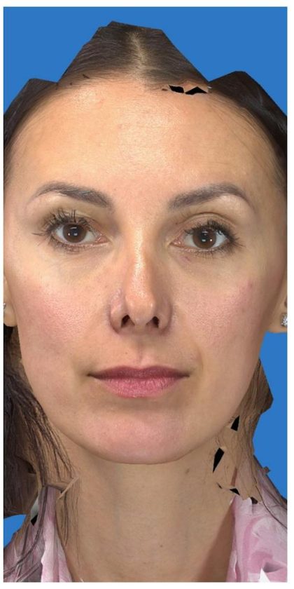 Aesthetic Facial Balancing Before & After Patient #1136