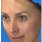 Aesthetic Facial Balancing Before & After Patient #1136