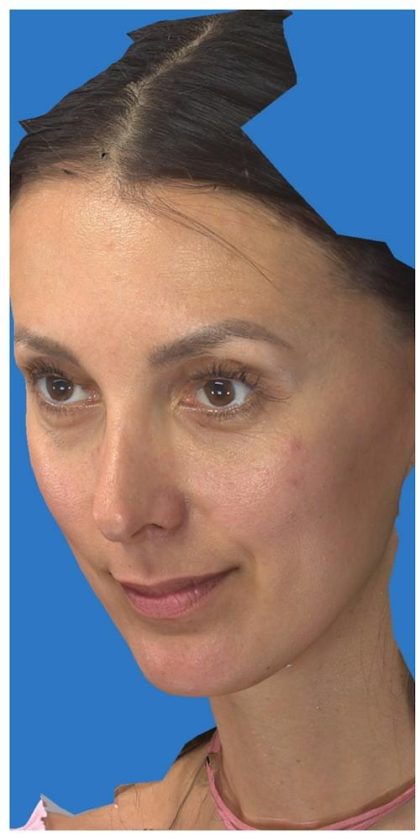 Aesthetic Facial Balancing Before & After Patient #1136