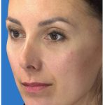 Aesthetic Facial Balancing Before & After Patient #1136