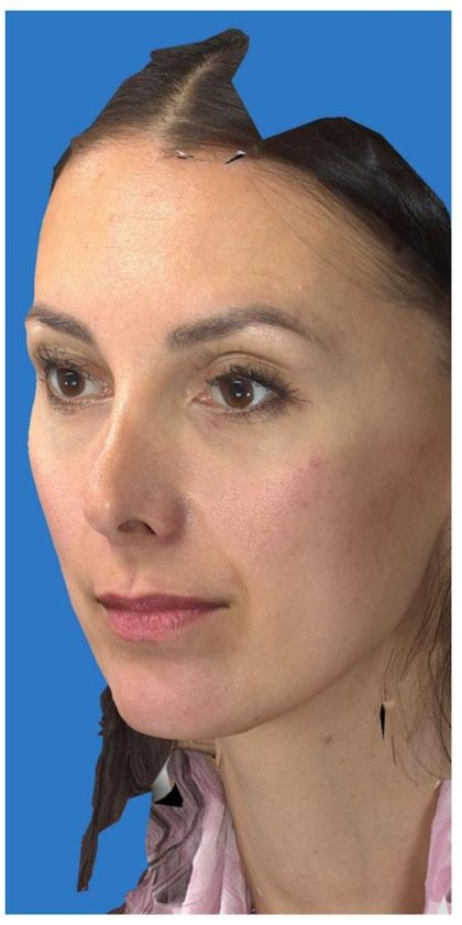 Aesthetic Facial Balancing Before & After Patient #1136