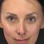 Aesthetic Facial Balancing Before & After Patient #1136