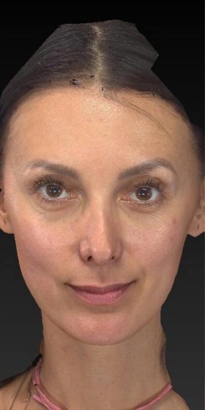 Aesthetic Facial Balancing Before & After Patient #1136