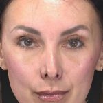 Aesthetic Facial Balancing Before & After Patient #1136