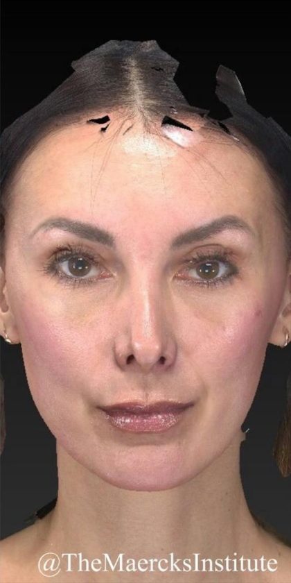 Aesthetic Facial Balancing Before & After Patient #1136
