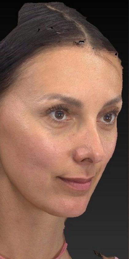 Aesthetic Facial Balancing Before & After Patient #1136