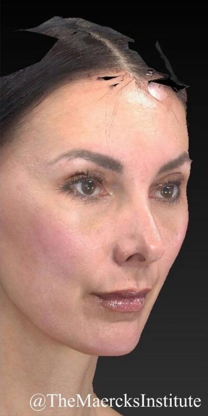 Aesthetic Facial Balancing Before & After Patient #1136