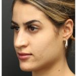 Aesthetic Facial Balancing Before & After Patient #1135