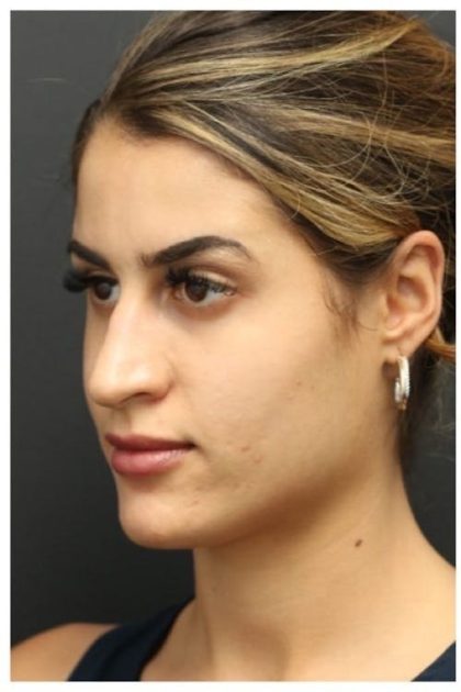 Aesthetic Facial Balancing Before & After Patient #1135