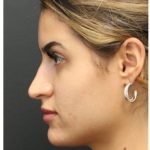 Aesthetic Facial Balancing Before & After Patient #1135
