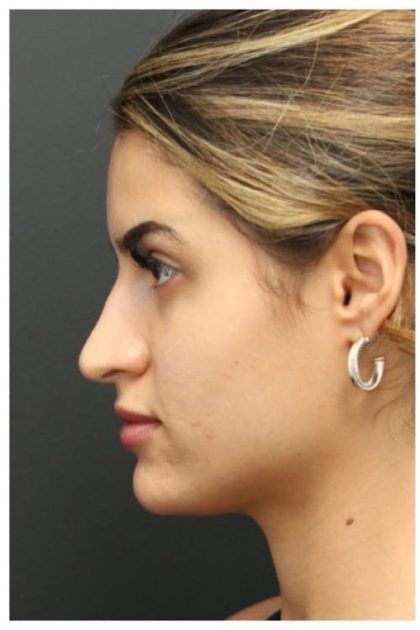 Aesthetic Facial Balancing Before & After Patient #1135
