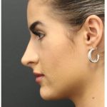 Aesthetic Facial Balancing Before & After Patient #1135