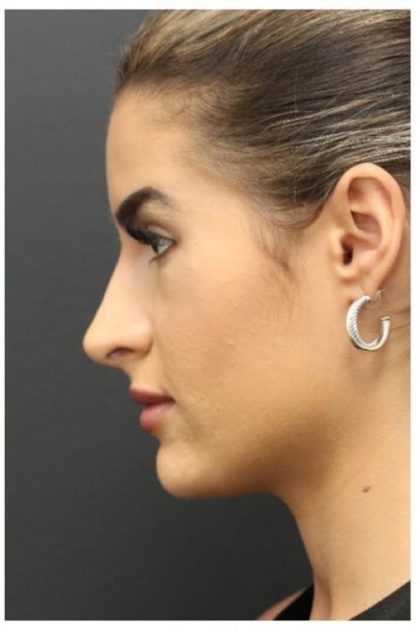 Aesthetic Facial Balancing Before & After Patient #1135